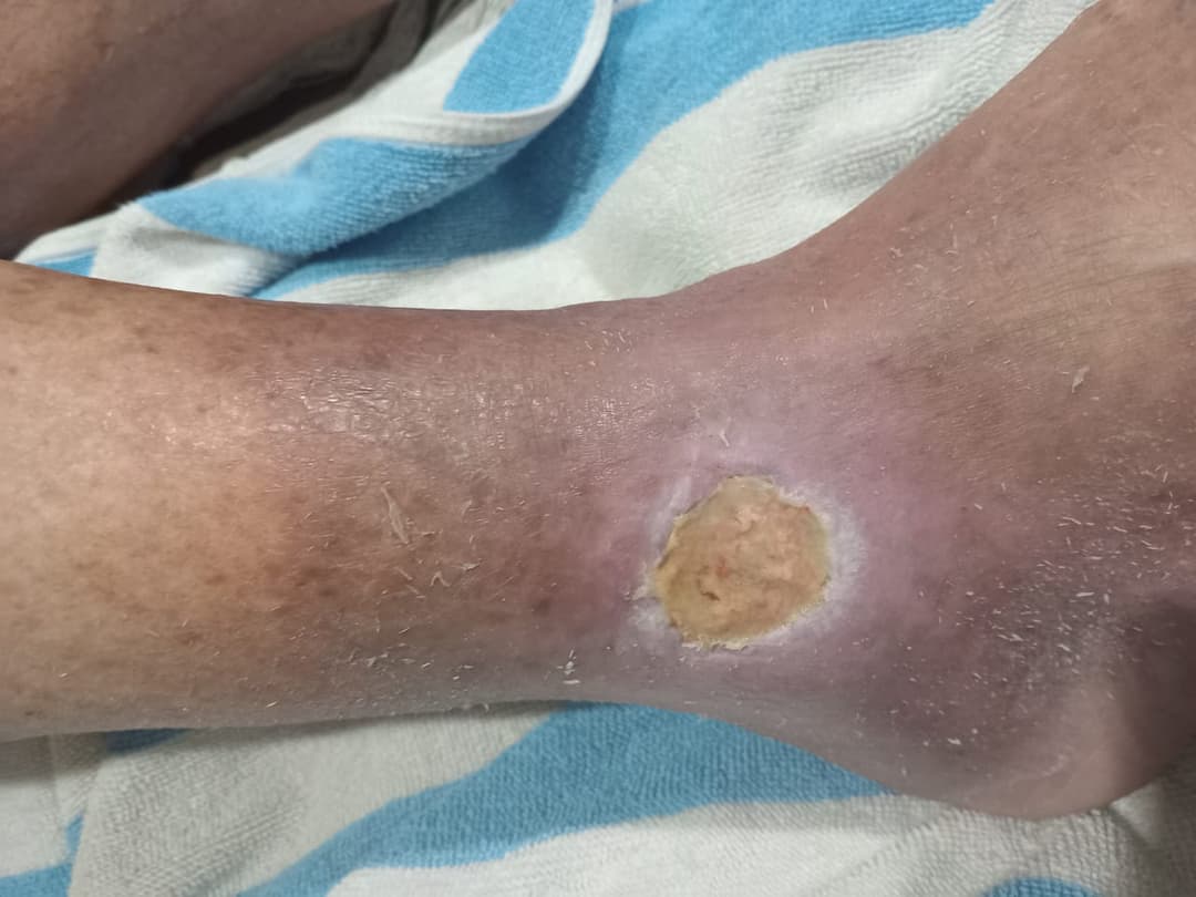 After Treatment 2