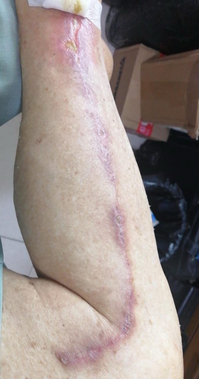 After Treatment 1